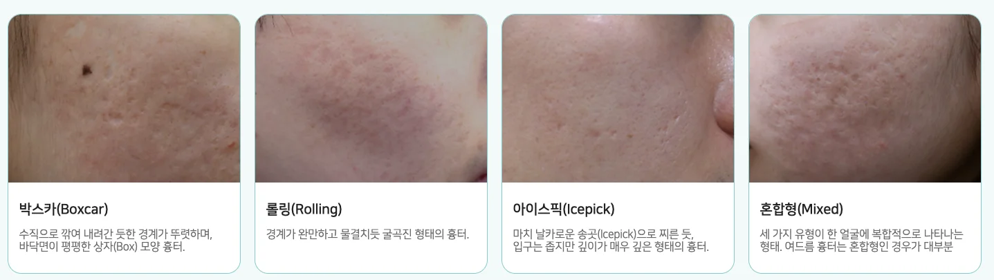 대전 대상포진흉터|여드름 흉터의 4가지 주요 유형별 특징 비교 및 설명